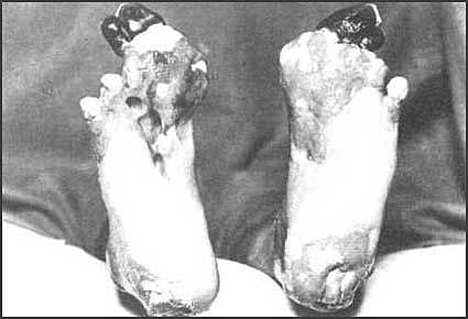 Trench Foot