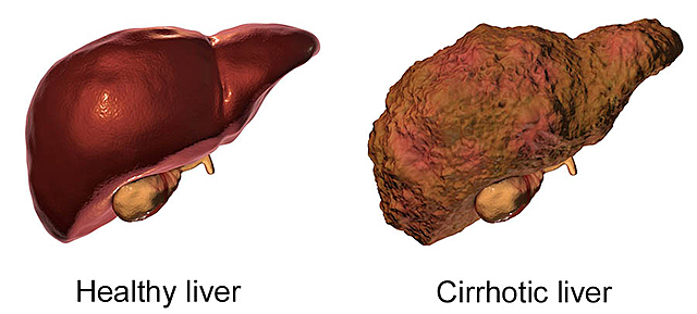 Cirrhosis