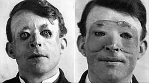 Plastic Surgery was Invented in WWI