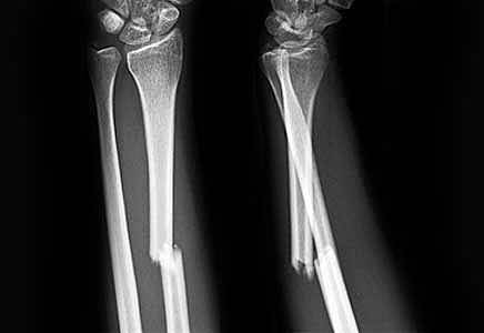 Fractura de radio y cubito