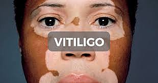 Vitiligo