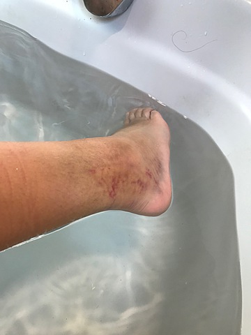 Broke my ankle the first time