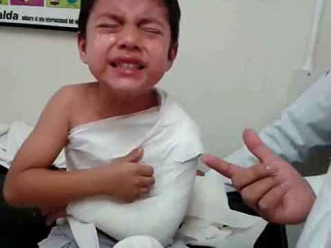 Trencament de clavícula.