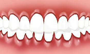 Enfermedad periodontal