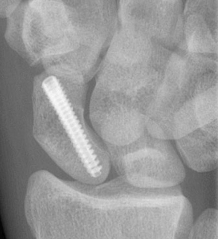 Fixation Reduction Surgery