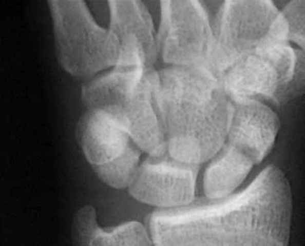 Broken Scaphoid