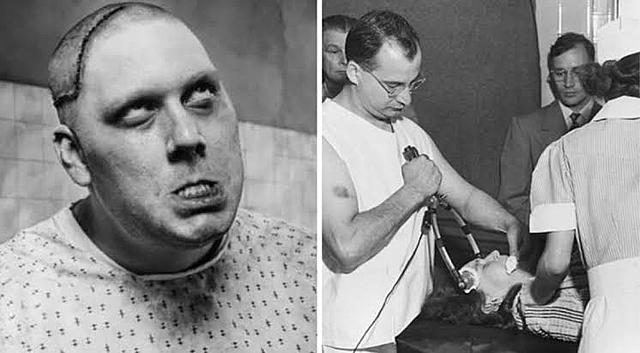 Inicio de la practica de Lobotomía