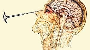 Lobotomía (neurocirugía) practicada por primera vez por Egas Moniz