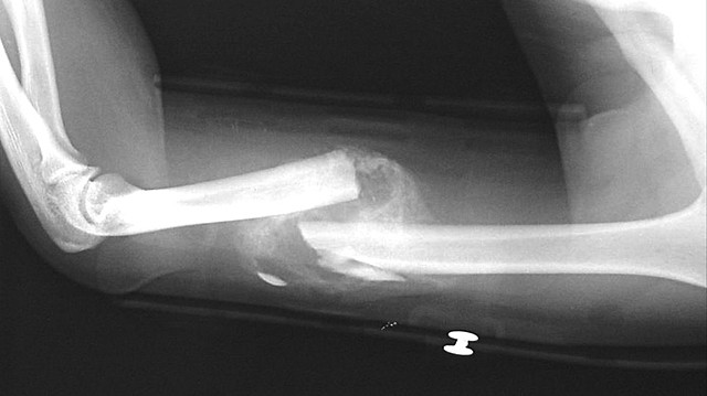 Fractura de mi brazo