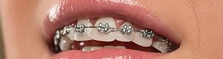 els brakets