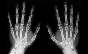 Radiació X-Wilhelm Conrad Roentgen