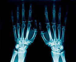 Raigs-x ( Marie Curie)