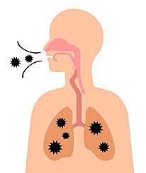 Neumococo conjugada: Neumonías, meningitis y otitis
