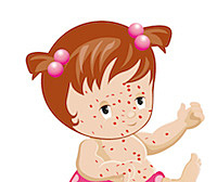 SRP: Sarampión, rubeola y paperas