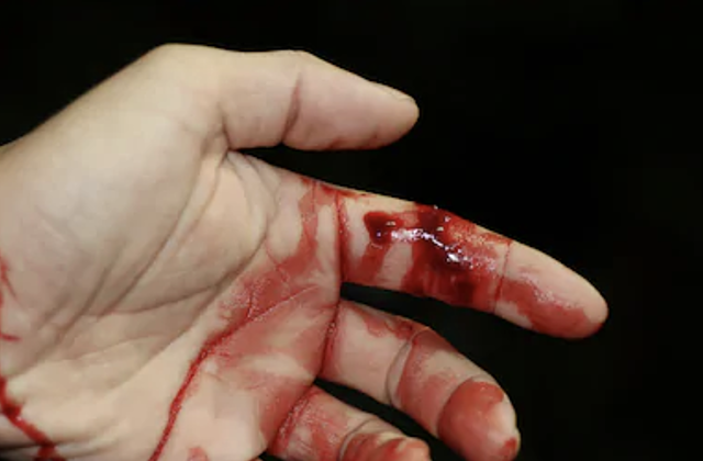 Bleeding hand