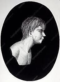 Jean Marc Gaspard Itard and "The Wild Boy of Aveyron"-Victor