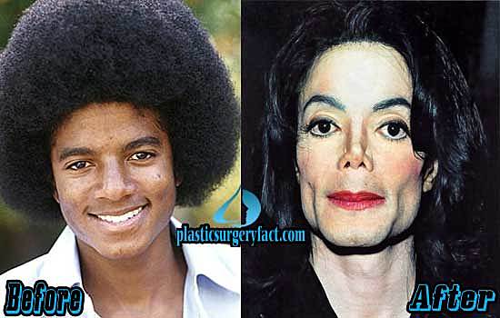 Jackson claims to have undergone two plastic surgeries (nose and chin), hard to believe. He broke his nose during a dance rehearsal. He underwent nasal plastic surgery, which was not very successful - he had trouble breathing.