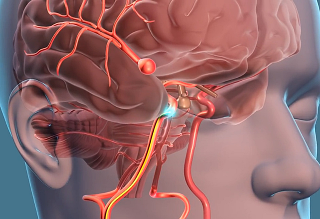 Charles Dubost realizó la primera cirugía de un aneurisma con resección y sutura de vasos.