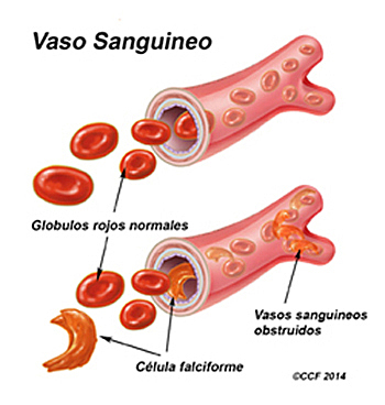 Linus Pauling descubrió que la anemia de las células falciformes era una enfermedad molecular producida por la alteración de un solo residuo de aminoácido en las cadenas beta de la hemoglobina.