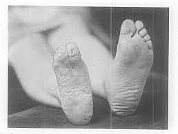 Epidemia de Ergotismo que afectó a toda Europa.