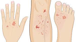 Concilio de Letrán. Se decidió que la lepra ya no era motivo de separación.