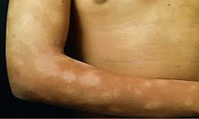 Los Reyes Católicos crearon la figura de los alcaldes de la lepra.