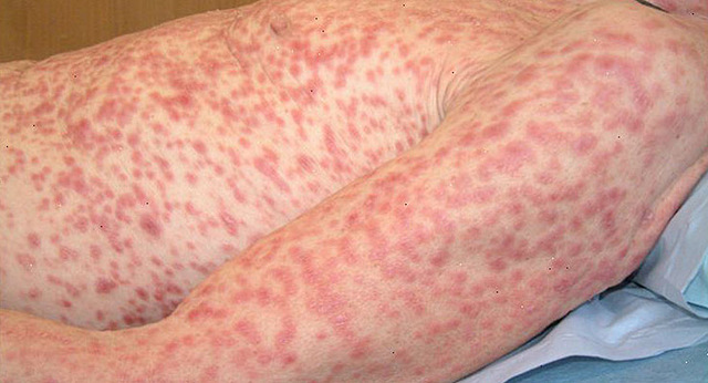 El médico español Francisco López de Villalobos describe la sífilis.