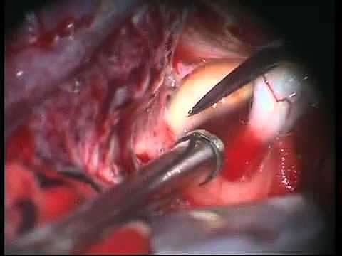 Primera cirugía de un aneurisma