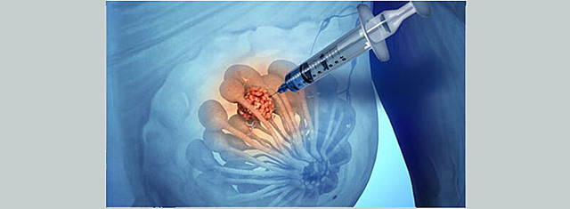 Comenzaron a utilizarse biopsias de vellosidades coriónicas en el diagnóstico prenatal.