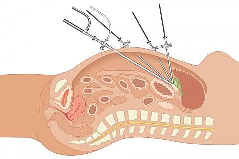 Simposio de la Asociación Quirúrgica Endoscópica, celebrada en Gotinga, se presentaron las novedades en el campo de la cirugía: la laparocopia.