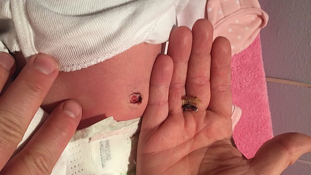 the icky belly thingy fell off