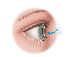 Primera cirugía de trasplante en seres humanos