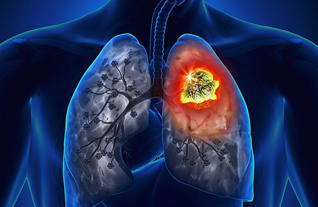 Helmut W Baer was diagnosed with Lung cancer due to exposure in the Lab