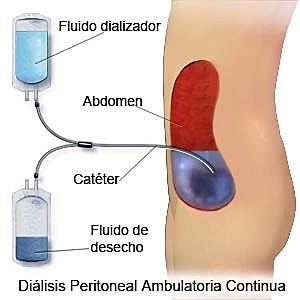 Desarrollo de la diálisis para la insuficiencia renal