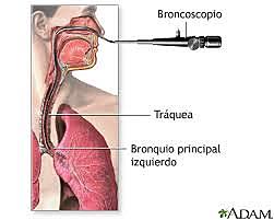 Broncoscopio