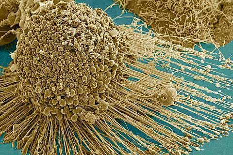 El uso de la Nanotecnologia para el tratamiento de cáncer