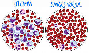 Reporte del uso de la terapia genética contra la leucemia