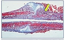 III. CALCIFICACIÓN DE CARTÍLAGO- REPARACIÓN TEJIDO ÓSEO