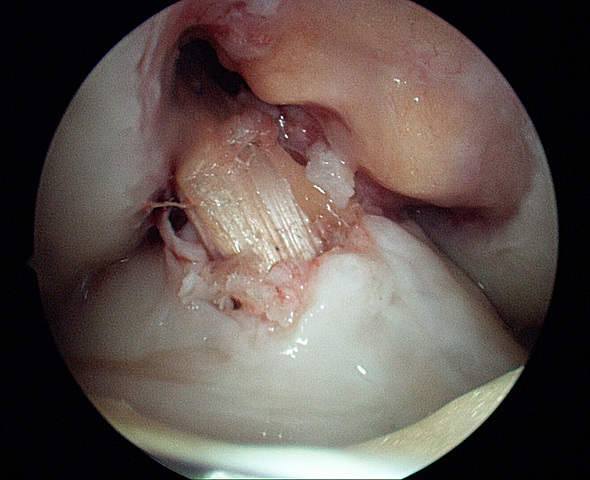 II FASE REPARADORA LIGAMENTOSA