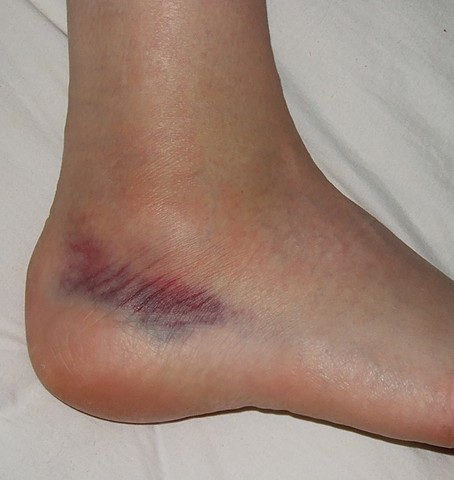 I. FASE INFLAMATORIA LIGAMENTOSA