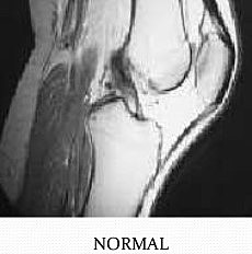III. FASE REMODELADORA LIGAMENTOSA