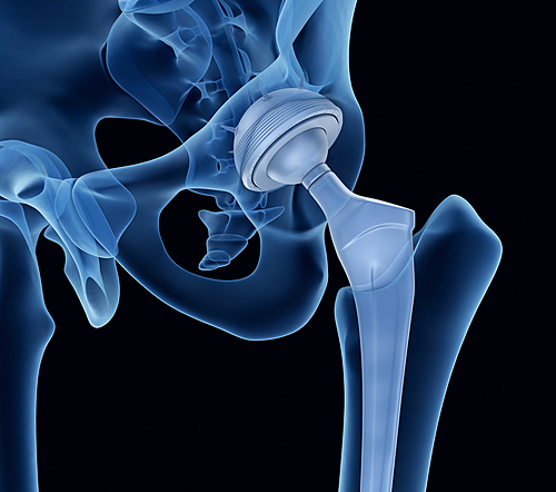 Hip replacement