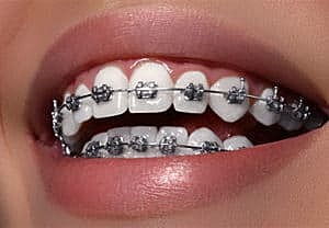 Got Braces