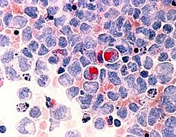 Secuenciación del genoma del cáncer.