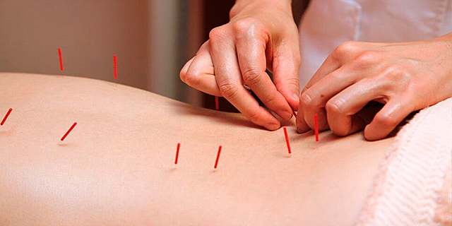 Medicina Tradicional China - Acupuntura.