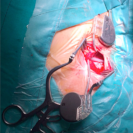 marcapasos con electrodos interno