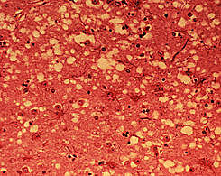 síndrome de las vacas locas pandemia