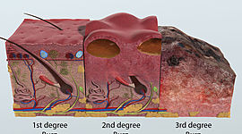 Timeline: Quemaduras, injertos y colgajos