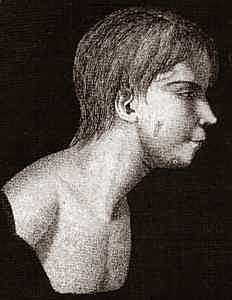 Tratamiento de "El niño Salvaje"