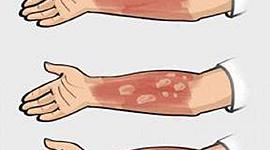 Timeline: Tratamiento Quirúrgicos de las quemaduras